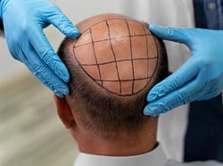 Baldness breakthrough: Taiwanese serum regrows hair in 20 days