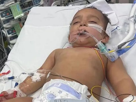 Sam Anwar, now 18 months old, faces urgent surgery after losing half his tongue and part of his airway. 