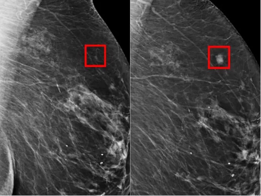Artificial intelligence detects breast cancer 5 years before it develops: In 2023, an AI model was able to identify normal digital breast tomosynthesis screening examinations, which decreased the number of examinations that required radiologist interpretation in a simulated clinical workflow.