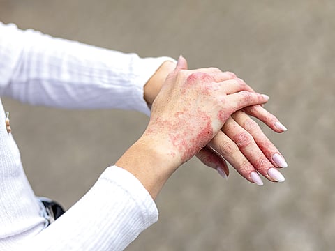 Psoriasis and Eczema: A holistic path to lasting skin health
