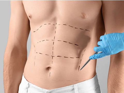 How modern abdominoplasty is solving chronic back pain by repairing core muscle damage