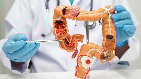 Why the incidence of colorectal cancer is rising among younger adults