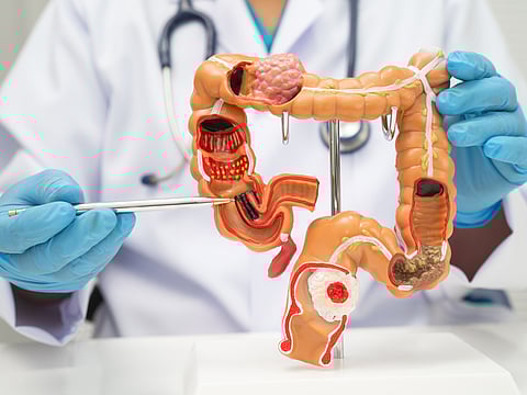 Why the incidence of colorectal cancer is rising among younger adults