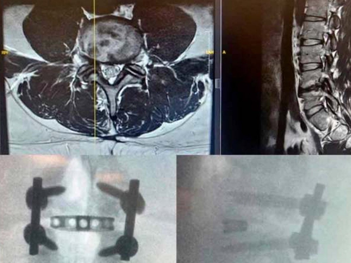 New ROCCIA MultiLIF implant marks leap in precision spine surgery in UAE.