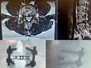 New ROCCIA MultiLIF implant marks leap in precision spine surgery in UAE.