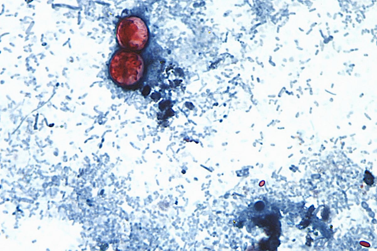 Cyclospora Outbreak Linked to Iceberg Lettuce Spreads to 15 States