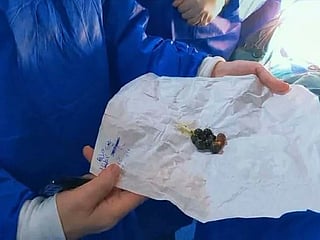 The girl initially underwent an upper gastrointestinal endoscopy through her mouth, allowing doctors to extract five magnets. 