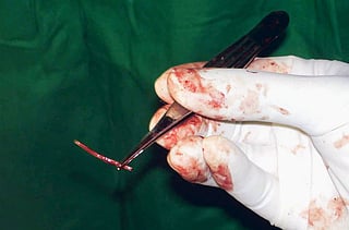 Iraqi doctors remove 24 tweezers, needles from man’s stomach