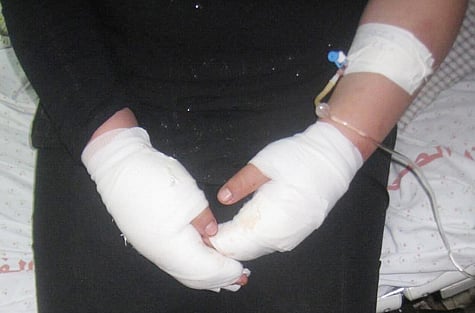 Majority of UAE burn cases involve children and maids