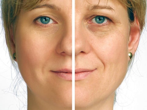 Should I have a facelift?