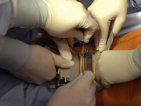 UK’s first full hand transplant a success