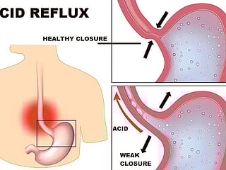 30% of UAE population suffers from acid reflux