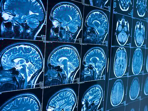 Dr Jacques Grill, a physician-researcher responsible since 2011 for the Brain Tumour Programme in the Department of Child and Teenage Oncology at Gustave Rouss, remembers having to tell Lucas's parents the difficult news that their son was going to die. Picture used for illustrative purpose only. 