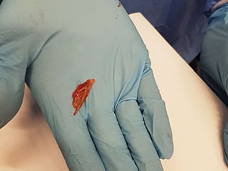 Fish bone stuck in woman’s lung removed in Abu Dhabi