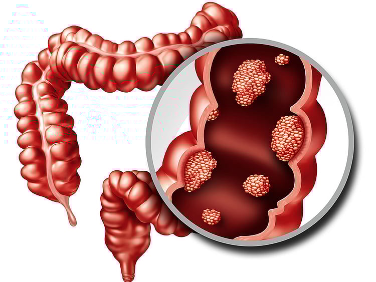 colon cancer chronic care