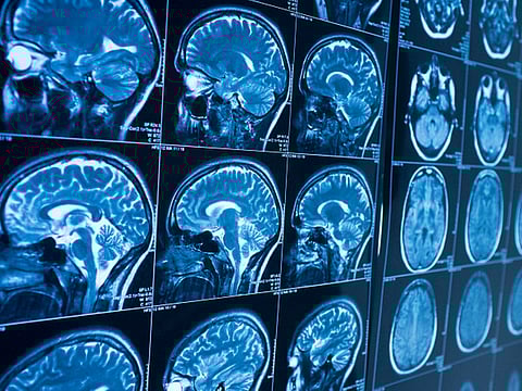 MRI brain scan. For illustrative purposes only