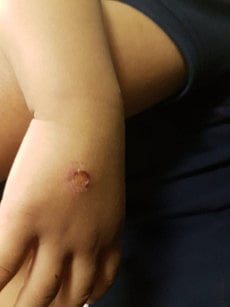 Mother accused of burning toddler with cigarette