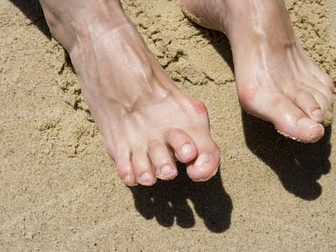 What can you do about a hammertoe?