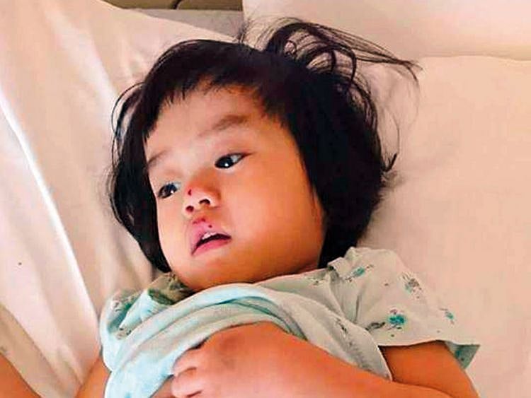 190119 biliary atresia