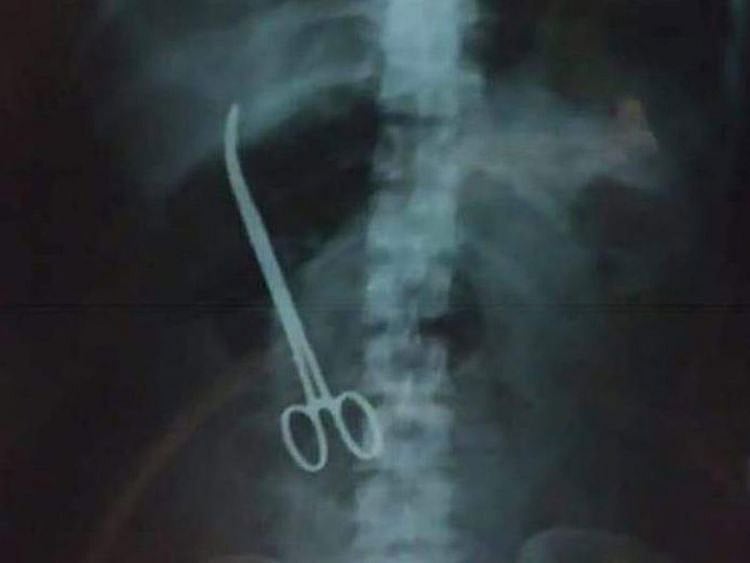 190209 forceps in tummy