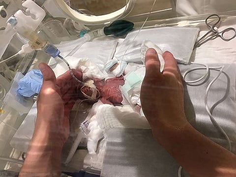 This undated handout released by Japan's Keio University Hospital on February 27, 2019 shows a five-day-old baby, who weighed 268 grams at birth, at the hospital in Tokyo.