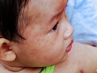 'Red flag' health alert raised after surge in measles cases in eastern Philippines