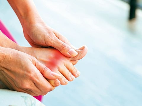 The prevalence of gout in the UAE has risen over the past 15 years