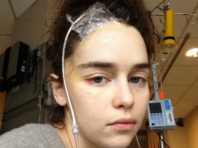 tab-Emilia-Clarke---reveals-brain-surgery-images-1554876046842