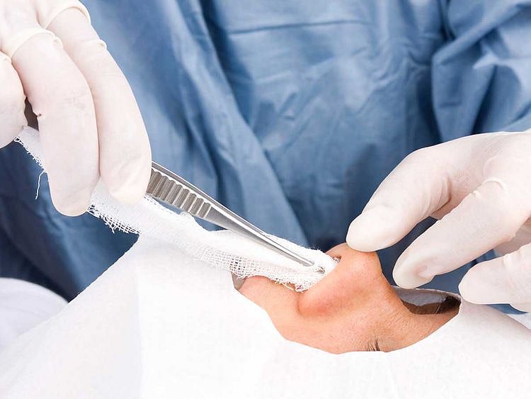 190509 rhinoplasty