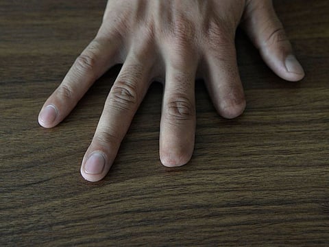 This photograph taken on September 30, 2019, shows a hand of Afghan writer Reza Khorami during an interview with AFP in Kabul, with fingers that were cut off in 2014 by the Tailban. With two fingers missing from his right hand, Afghan writer Reza Khorami struggles to tap out stories on his keyboard.