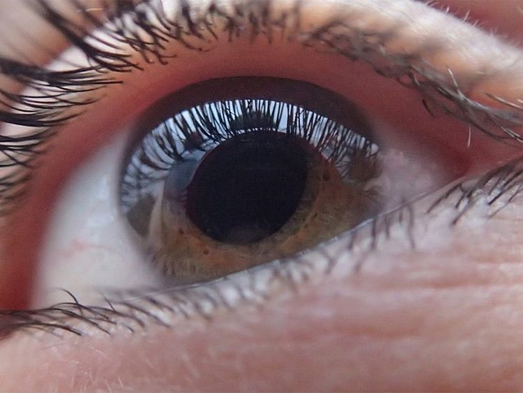 Here's another reason for you to get cataract surgery