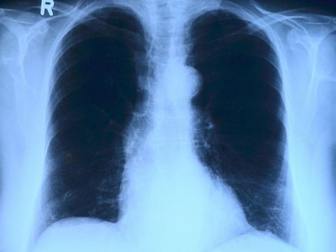 An X-ray image of the lungs.