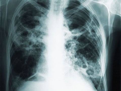 This 1966 image made available by the Centers of Disease Control and Prevention shows a chest x-ray of a tuberculosis patient. According to results reported Tuesday, Oct. 29, 2019 at a conference in India and published by the New England Journal of Medicine, an experimental vaccine has proved 50% effective at preventing latent tuberculosis infection from turning into active disease in a three-year study of adults in Africa. 