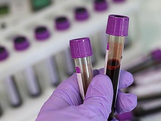 Blood test to detect breast cancer signs 5 years sooner