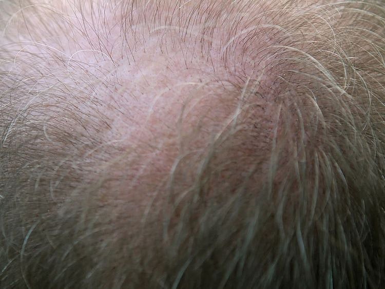 Adult balding