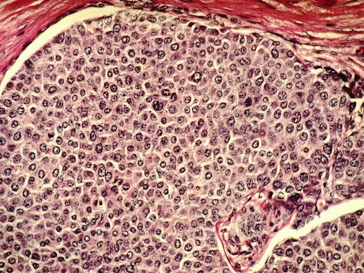 Oxygen-starved tumor cells have survival advantage that promotes cancer spread