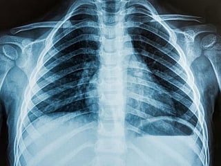 New AI tool can detect COVID infection from chest X-rays with 98% accuracy