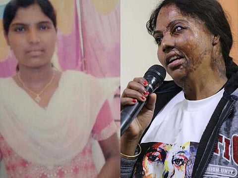 Treatment for acid attack victims like Bala is a prolonged one and they go through several surgeries, each more painful than the other.