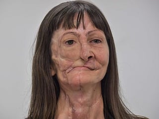 Low-cost prosthesis gives Brazil cancer survivor a new face