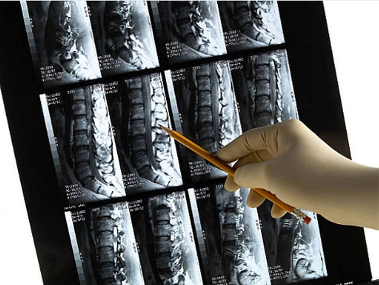 Is your lifestyle affecting your bone health?