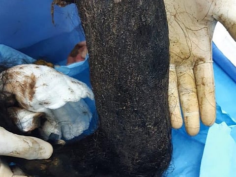 A mass of hair removed from a woman's stomach at a Taif hospital. 