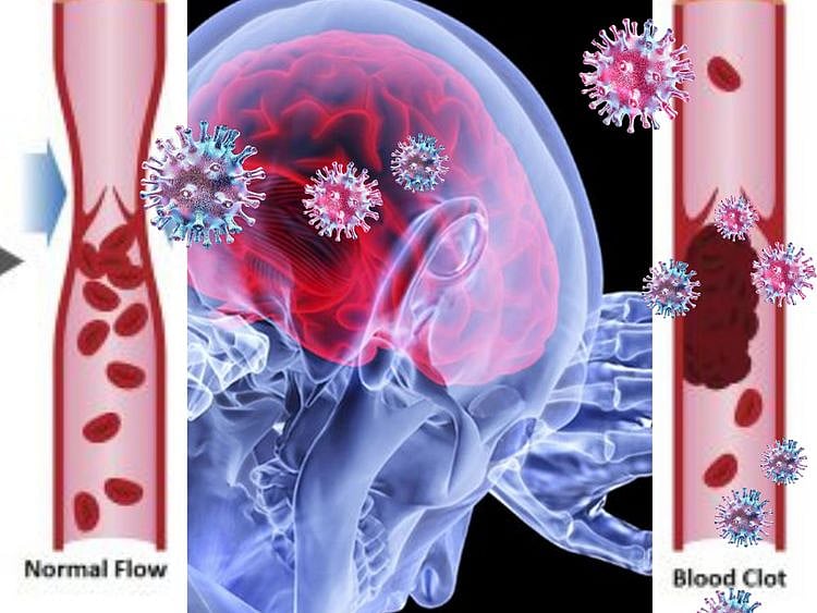 Blood clot coronavirus