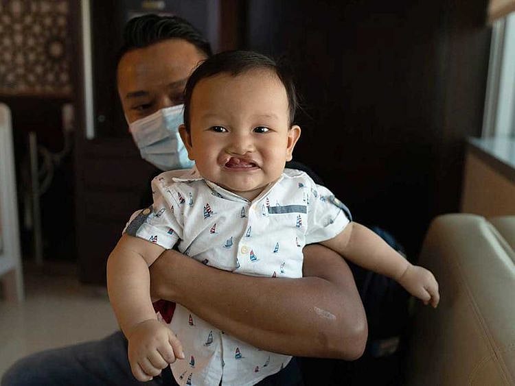 Cleft lip surgery UAE