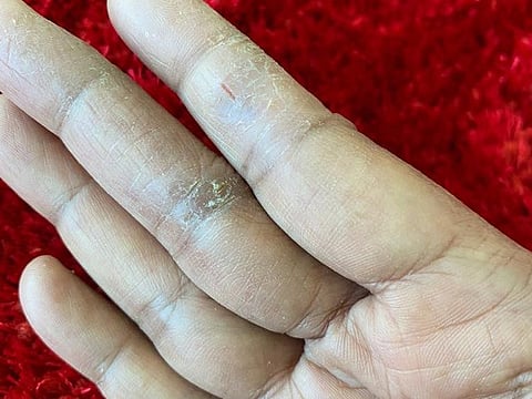 A close up of Jamila's hand. Due to frequent use of sanitisers, her hands are raw, dehydrated with split dry skin on her palms and fingers that makes it difficult for her in a professional situation. 