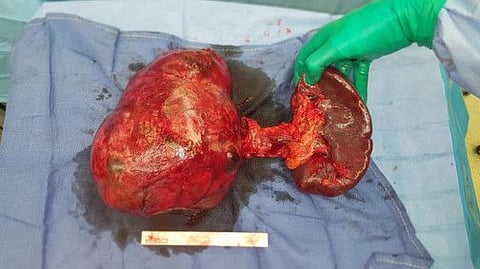 Doctors remove a 3.5kg cancerous tumour from a 50-year-old woman's pancreas  in Abu Dhabi.