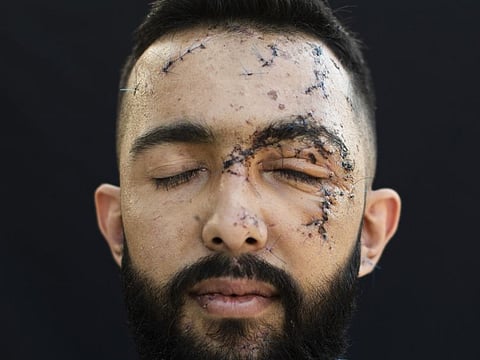 In this August 14, 2020 file photo, Hussein Haidar, 27, who got injured at his office during the August 4 explosion poses for a photograph at his parents' house in Beirut.