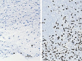 Unusual treatment shows promise for kids with brain tumours
