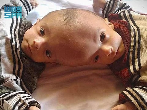 Conjoined twins Yousuf and Yassin.