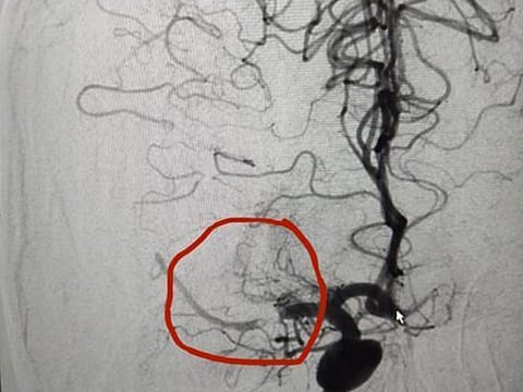 The CT scan image showing the are of arterial occlusion.  