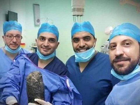  Doctors pose with the mass of hair removed from the woman's stomach in Jordan.